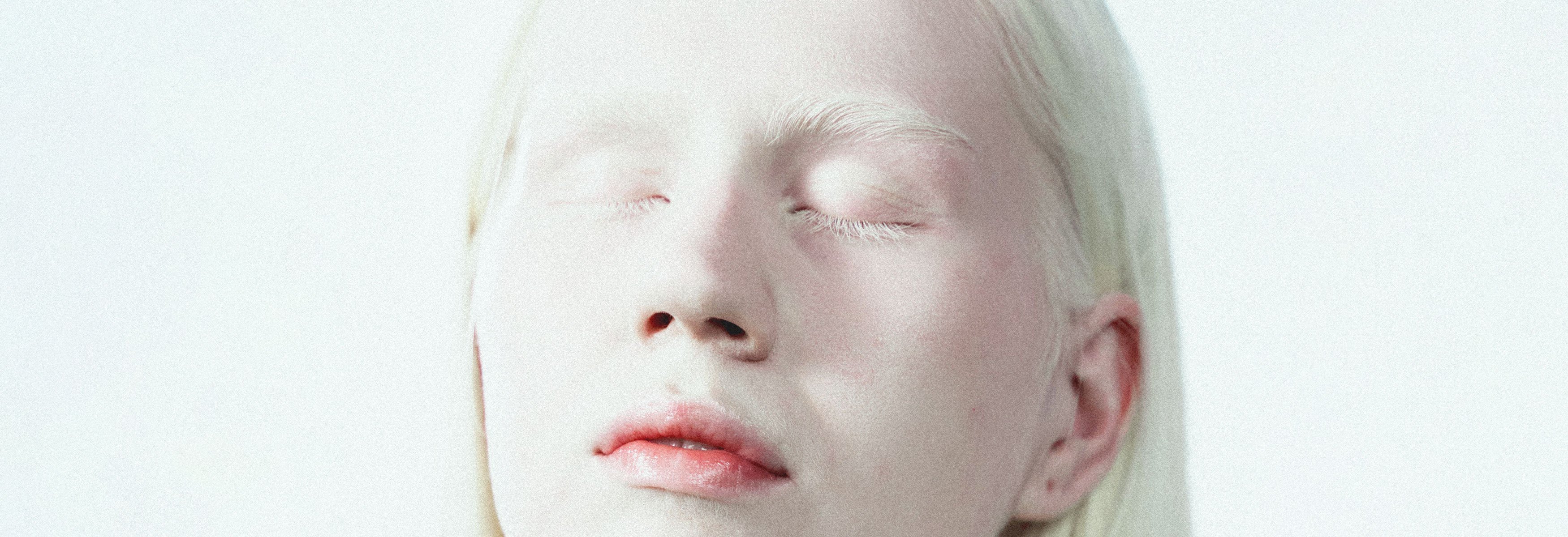 Альбинизмом страдают. Банши альбинос. Десислава альбинос.